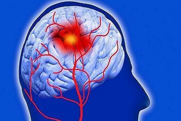 ریسک ابتلا به زوال عقل در افراد سکته ای دو برابر است