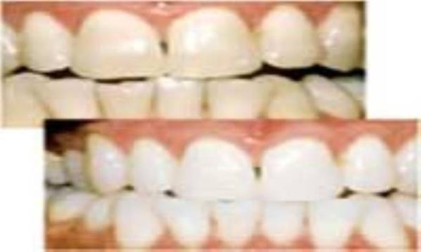 5 نکته درباره سفید کردن دندان ها